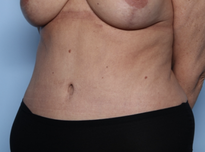 Tummy Tuck Before & After Patient #34291